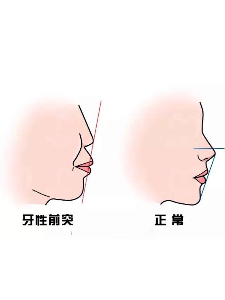 牙性的区别在于是「骨」还是「牙」,上颌骨发育过度的突即为骨性前突