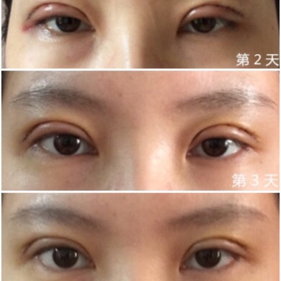 "死鱼眼"光做双眼皮手术就能改善吗