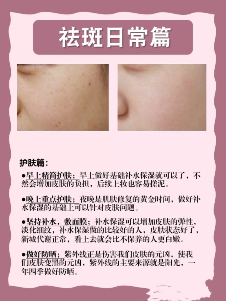 小姐姐们都被长斑困扰嘛你知道六种斑点类型!你是哪一种吗?