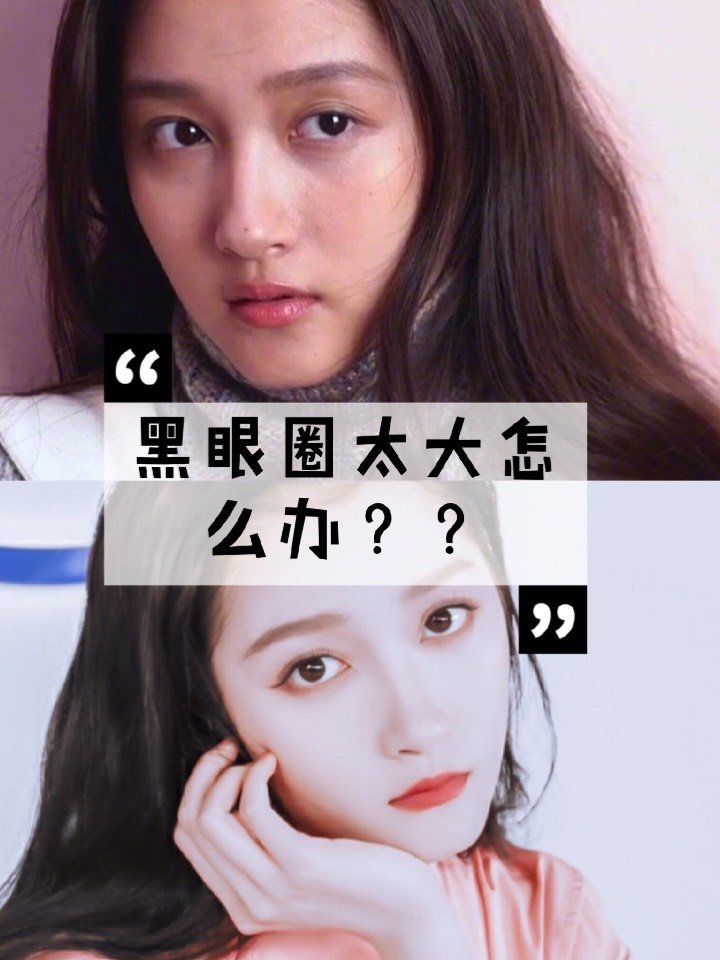 造成黑眼圈的原因有 1遗传体质,先天就有黑眼圈 2长期睡眠不足 3