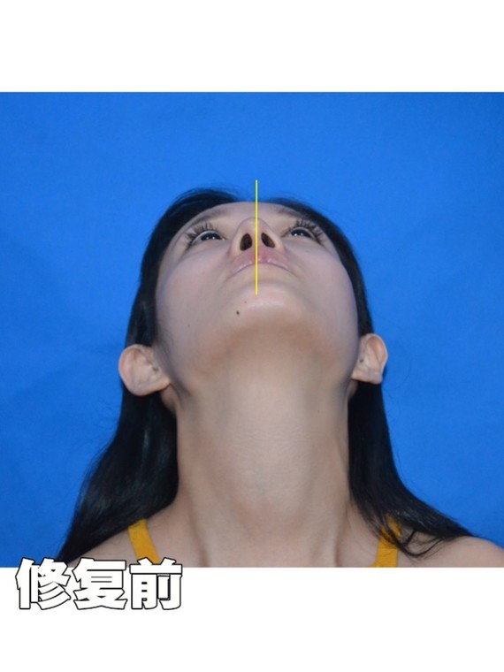 鼻修复案例#假体隆鼻造成的歪鼻,如何修复?92.隆鼻