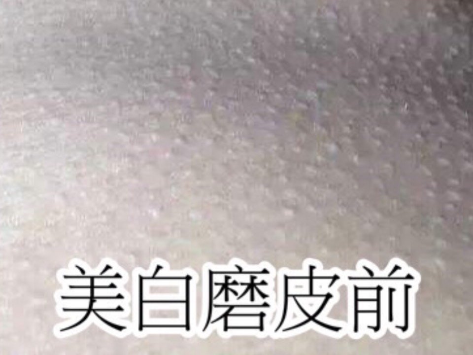 日常中我们常说的鸡皮肤,学名为毛周角化症,又称毛周角化病或毛发
