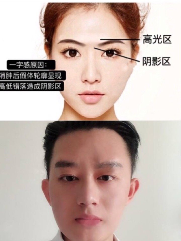 74【整形劝退】眉弓真没想象那么好7515躲开了