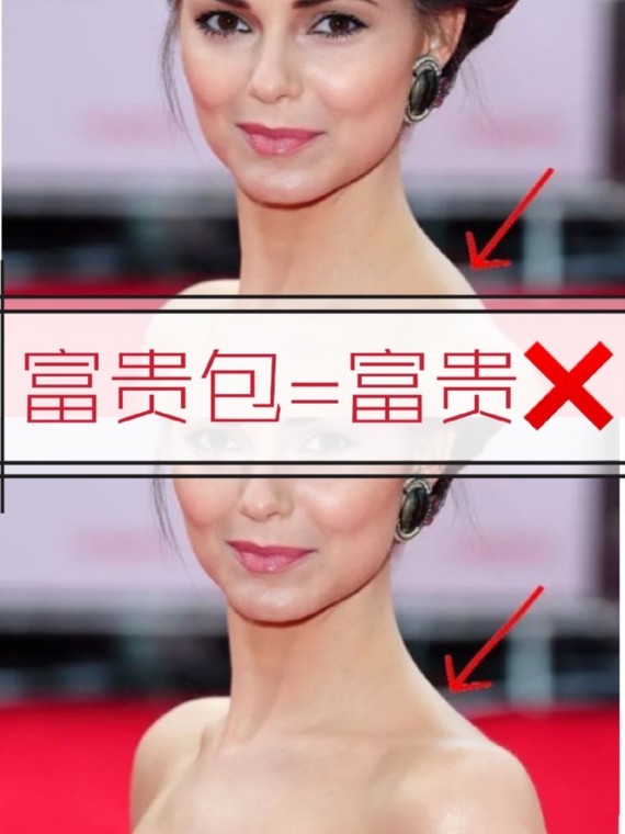 富贵包#有一种性感叫做"背影杀#后背吸脂不知道_圈子-新氧美容整形