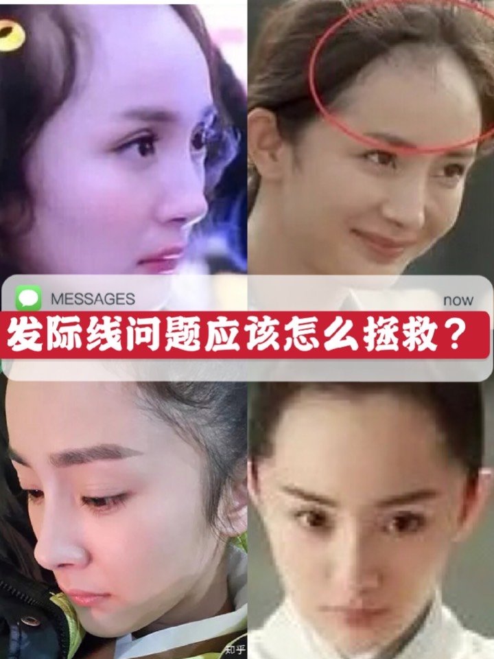 许多明星的发际线就有偏高了问题,例如典型的杨幂,赵丽颖,程潇.