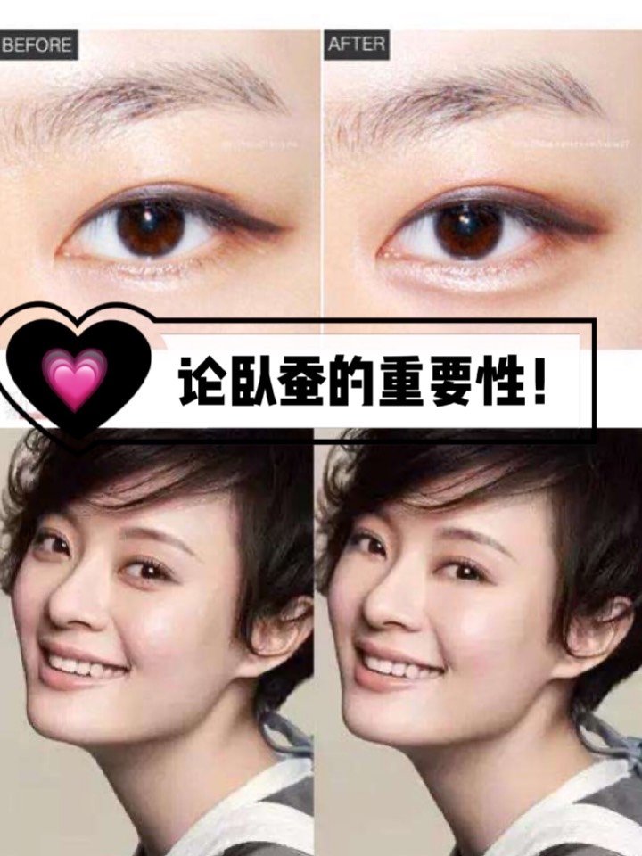 卧蚕的重要性
