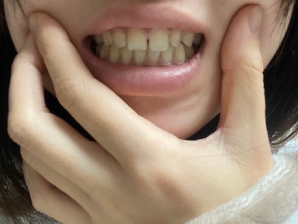 牙缝大 第一次去医生会先给你磨牙 拍照 取模 问问你想要怎么样的牙齿