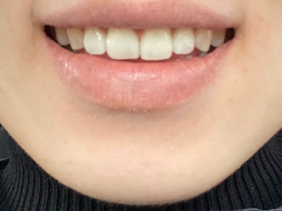 门牙牙缝大 第一次去医生会先给你磨牙 拍照 取模 _圈子-新氧美容整形