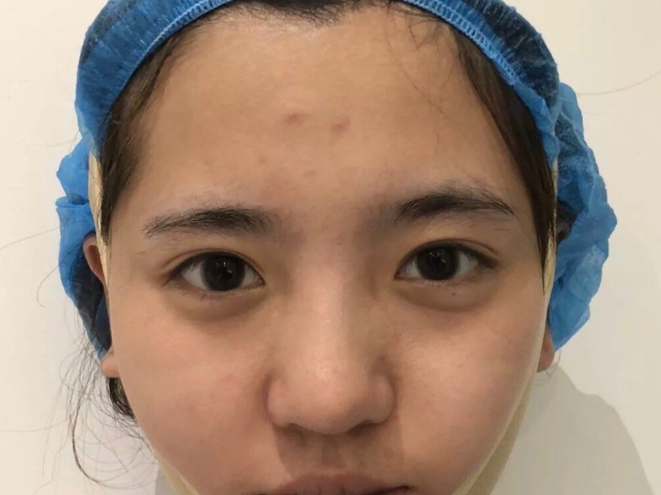 脸上的婴儿肥让脸看起来