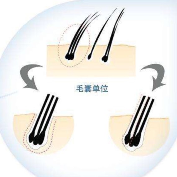 大家都知道植发是按照毛囊单位收费的,很多发友觉得一个毛囊一根头发
