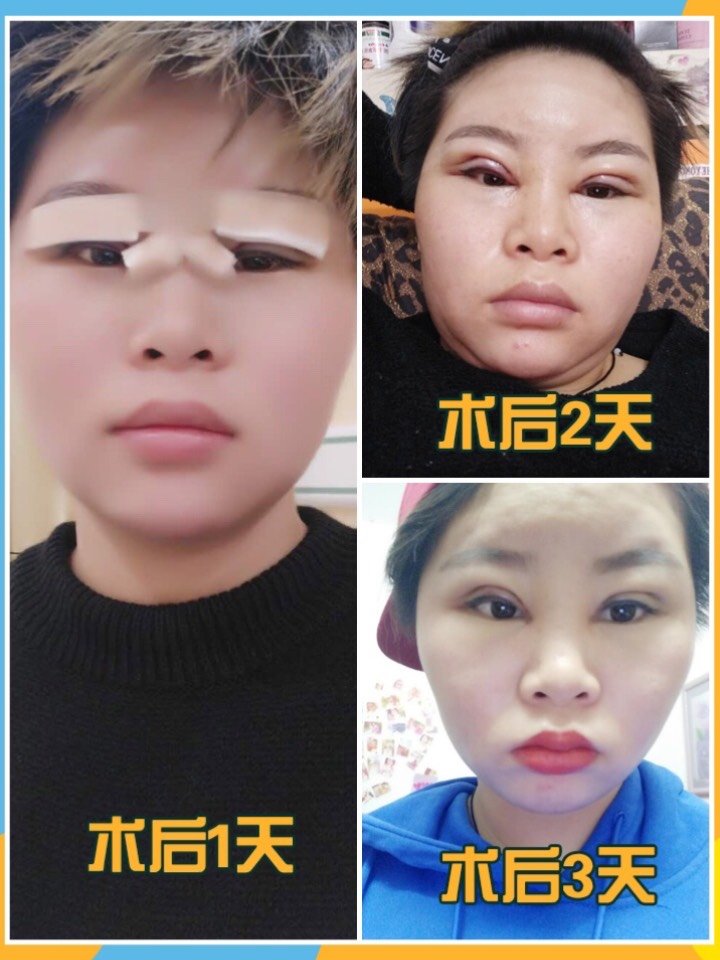 单眼皮 小眼症 通通走开【韩妃伊尔丝美眼案例分享】