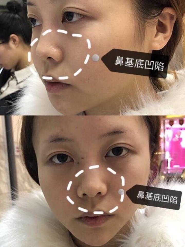 垫鼻基底,假体,自体软骨,玻尿酸哪种材料更好?♀♀