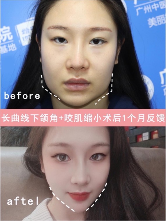 下颌角截骨 咬肌切除术后面部轮廓更精致