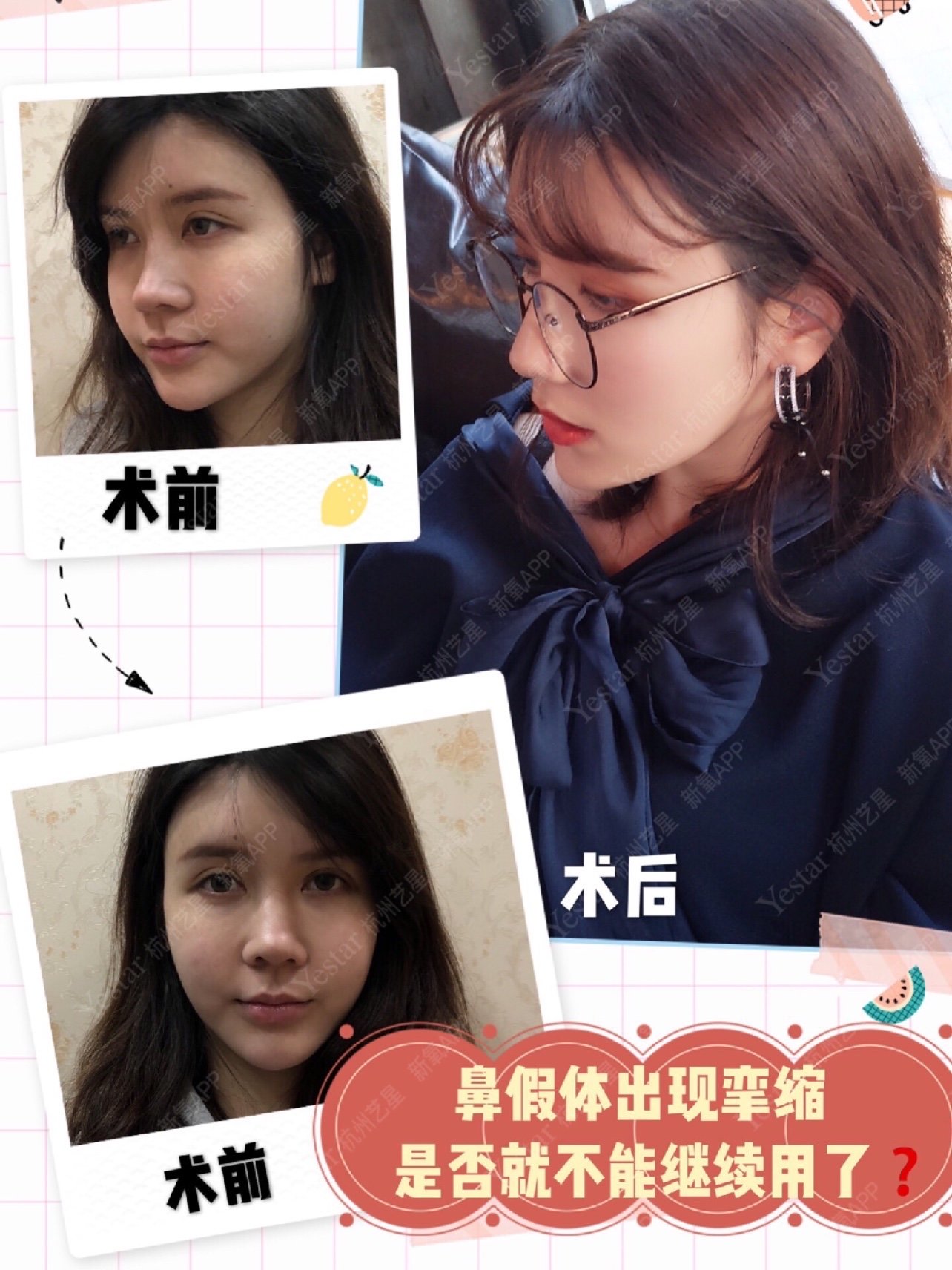 比如说假体挛缩,好好的鼻子做完隆鼻后鼻尖往上走,鼻头就会越来越朝天
