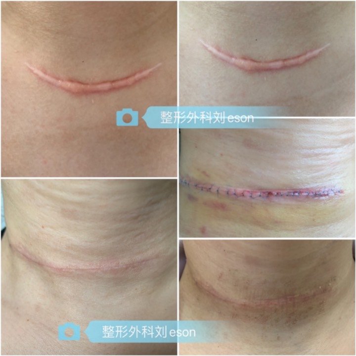颈部甲状腺瘤切除术后增生性疤痕1年,疤痕修复术后恢_圈子-新氧美容