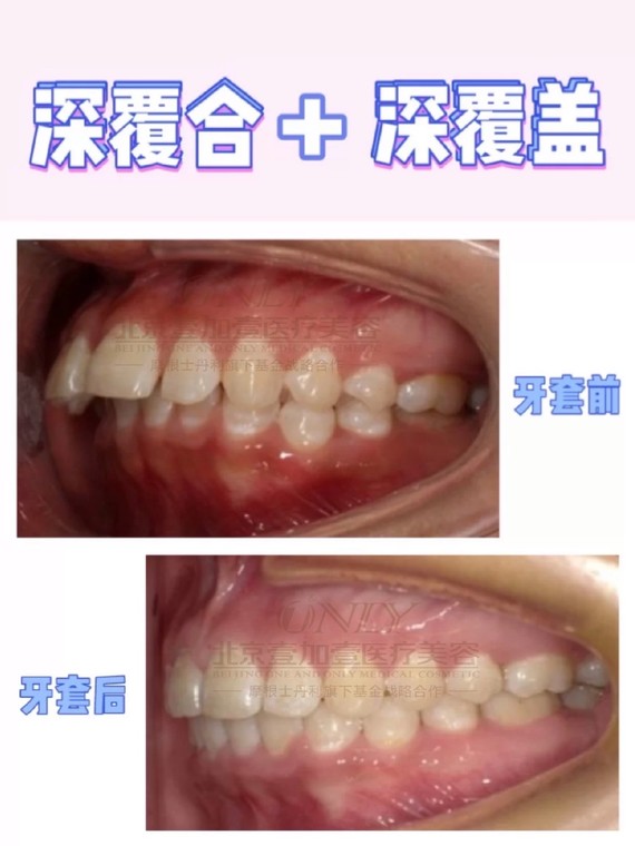 自测指南|深覆合or深覆盖,教你3秒区分