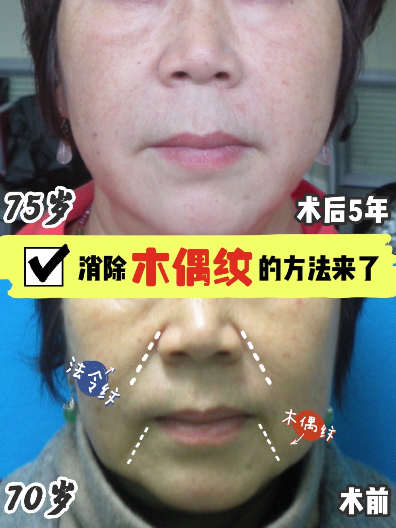 消除木偶纹的方法来了,3倍提升保持10年