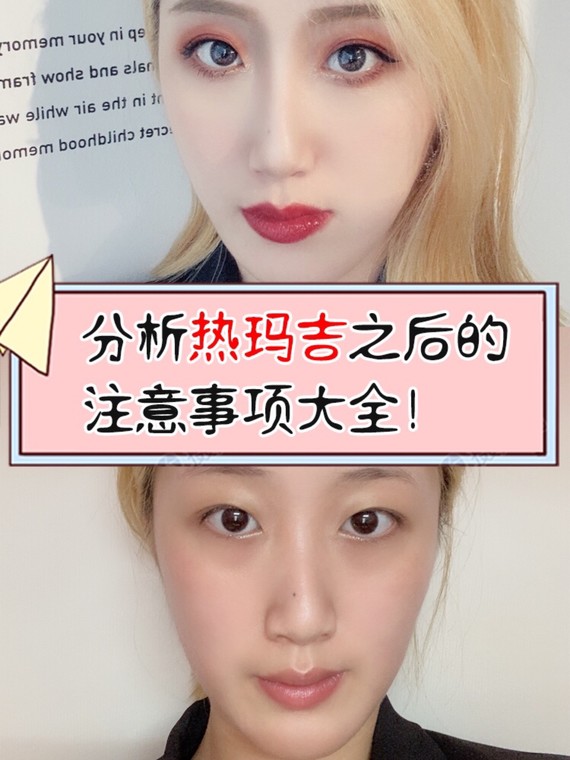 做完热玛吉之后的效果以及注意事项.