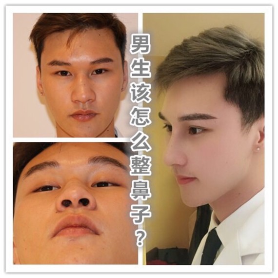 案例:男生该怎么整鼻子?