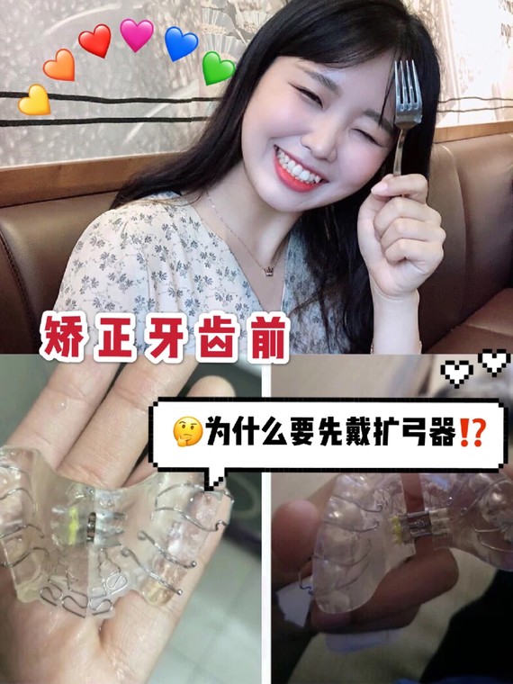 扩弓器一般是用于生长发育期的青少年牙齿矫正前期治疗,但现在也经常