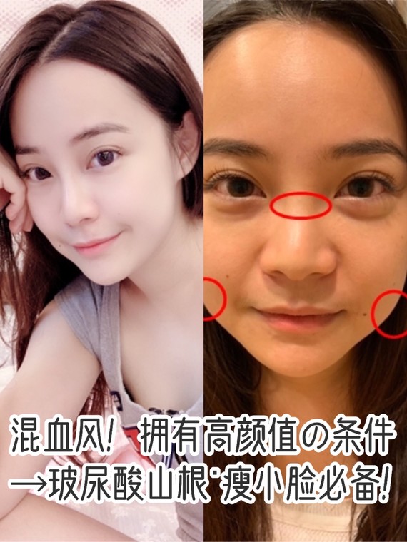 拥有高颜值の条件→玻尿酸山根 瘦小脸必备!_圈子-新氧美容整形