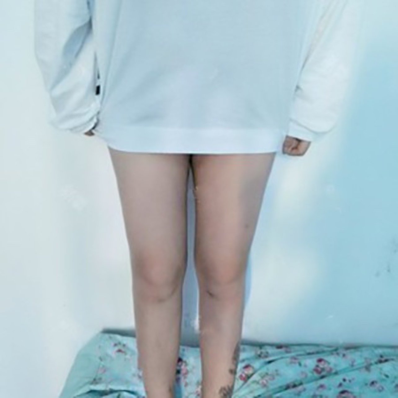 【吸脂】大腿 ,【5g光雕腿部吸脂】赘肉不在,尽情秀美腿