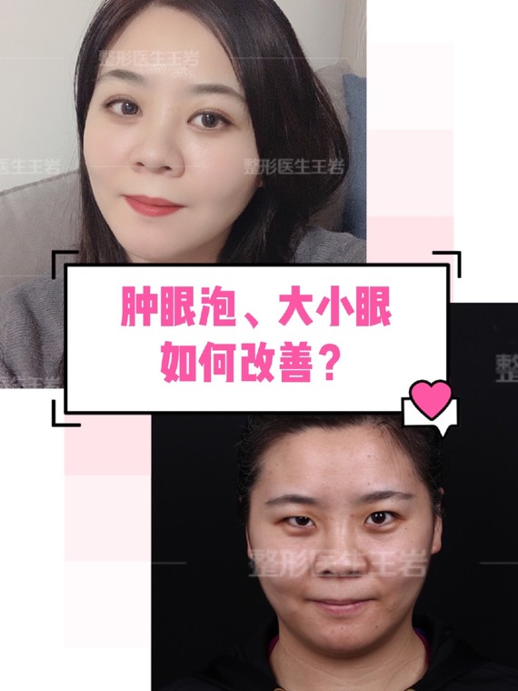 大小眼肿眼泡,怎么改善?如何塑造动态美眼?