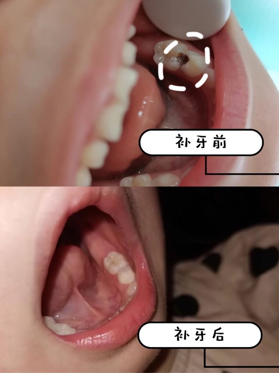 牙齿上的一个黑洞引发的惨案