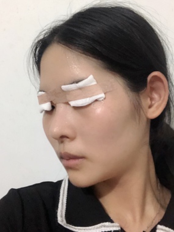 现在双眼皮手术越来越成熟,很多女生昨晚双眼皮不冰敷 也不热敷 甚至