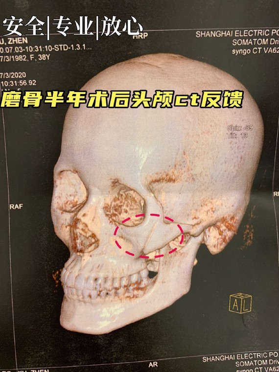 颧骨颧弓下颌角磨骨老顾客半年头颅ct反馈效果