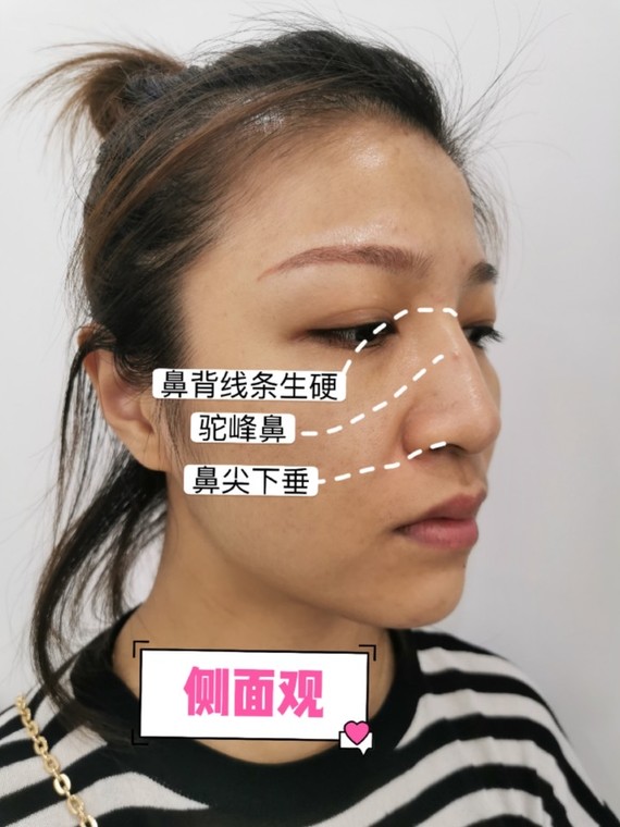 超肋鼻修复反馈,告别大鼻头"假"鼻子!