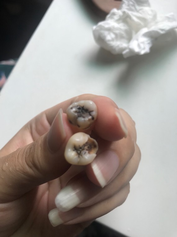 拔掉智齿等待正畸