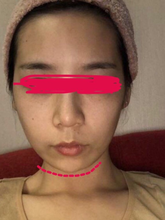 我的下巴打完童颜针后出现来增生凹凸不平的症状!
