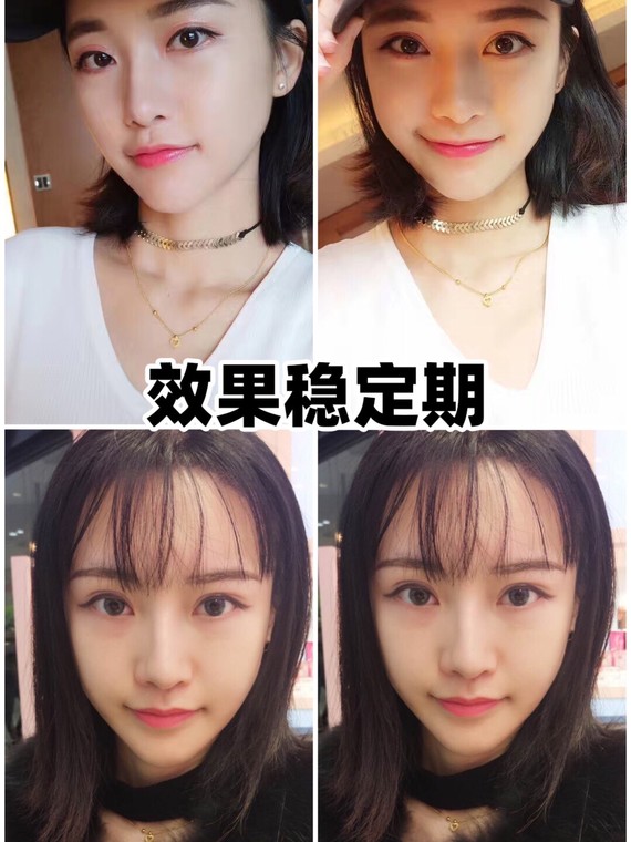 双眼皮多宽才算不窄好看又自然