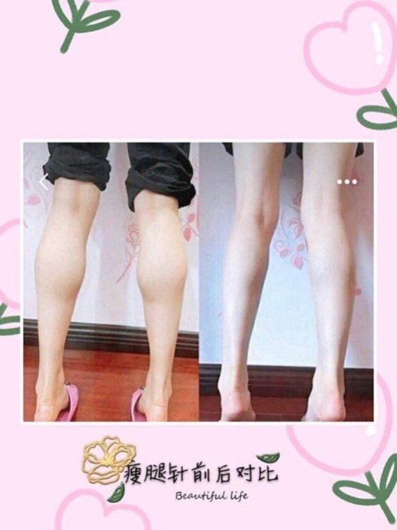 打了瘦腿针后,可以跑跳吗?影响活动吗?