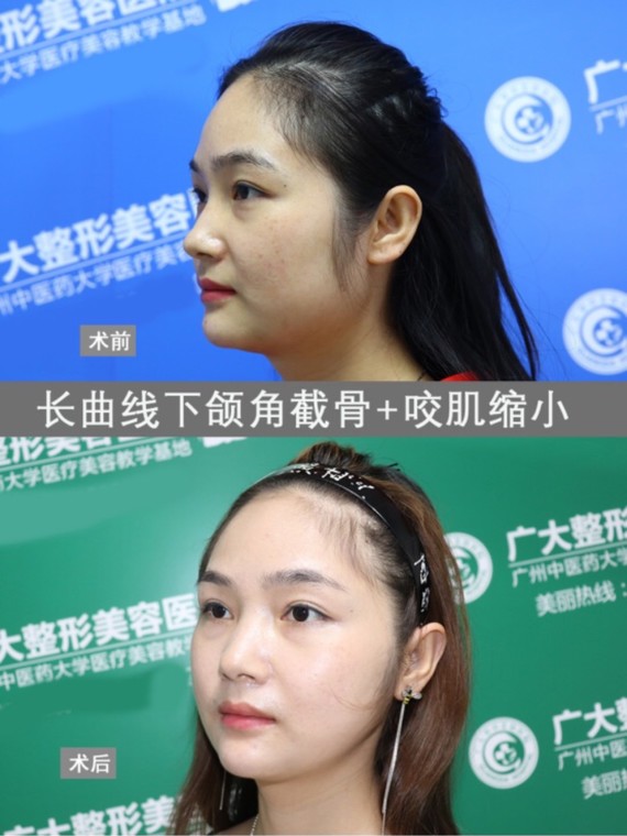 下颌角 咬肌适量切除