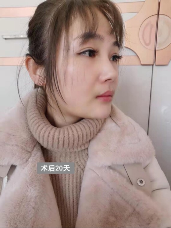 咬肌切除通常是跟下颌角截骨手术同时进行,只对小部分咬肌实施切除