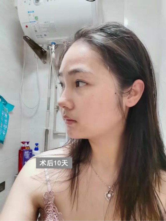 咬肌切除通常是跟下颌角截骨手术同时进行,只对小部分咬肌实施切除