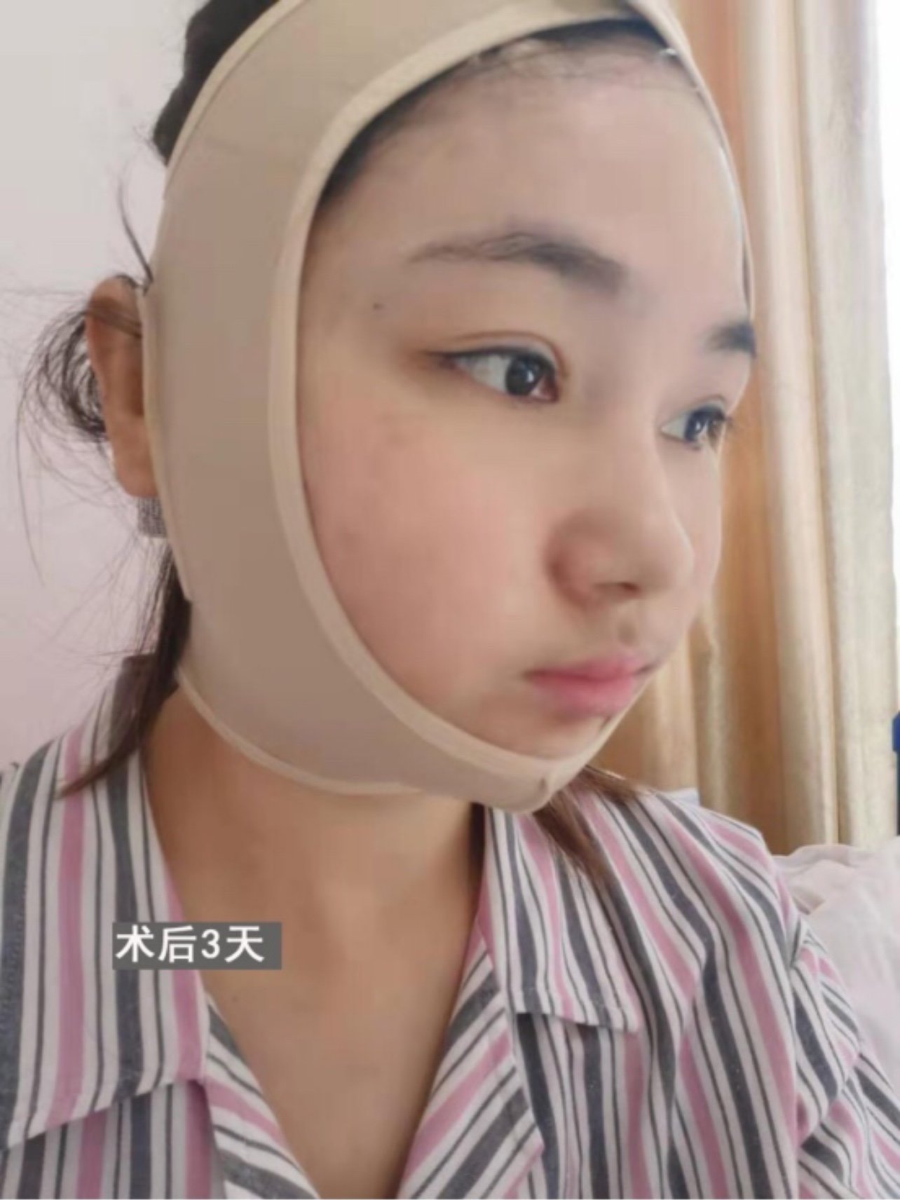 下颌角 咬肌适量切除