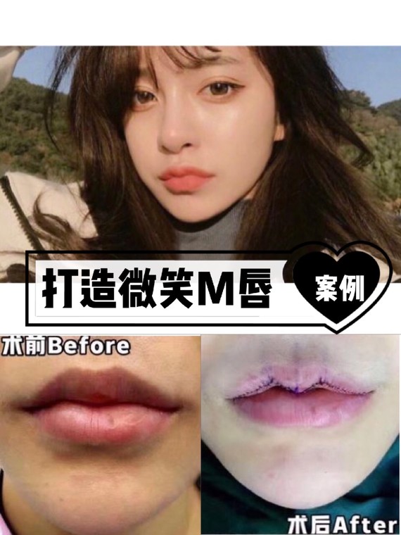 今天又是一位来改造唇形的小姑娘,想要改造成微笑唇～_圈子-新氧美容
