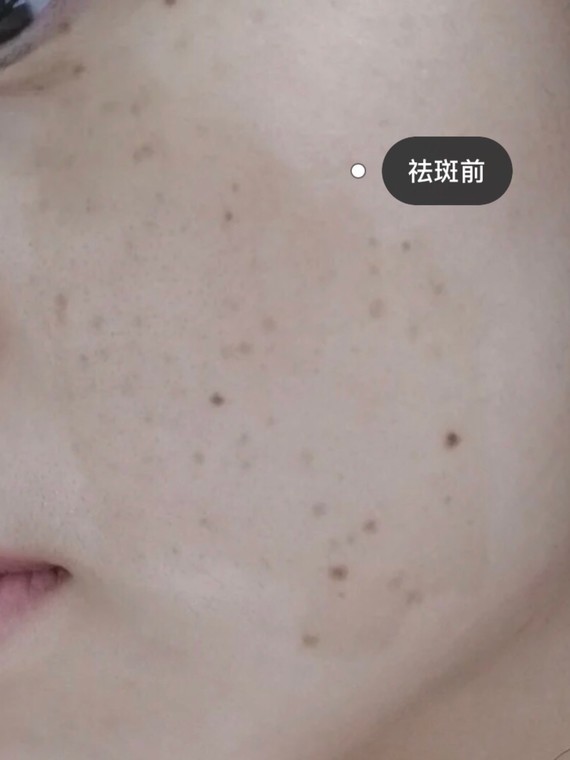 今天来分享一下我的牛奶咖啡斑,这个是属于遗传性的斑