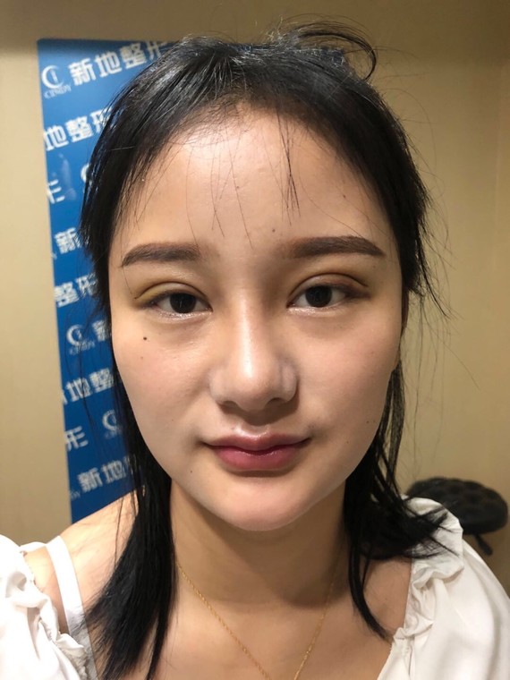 什么样的眼型做了双眼皮会好看?