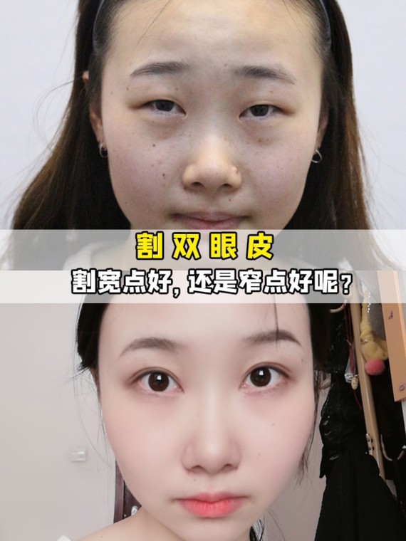 割双眼皮宽点好,还是窄点好呢