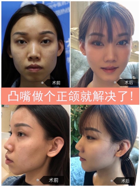 9393鸟嘴凸嘴做个正颌就解决了!9090很多人说