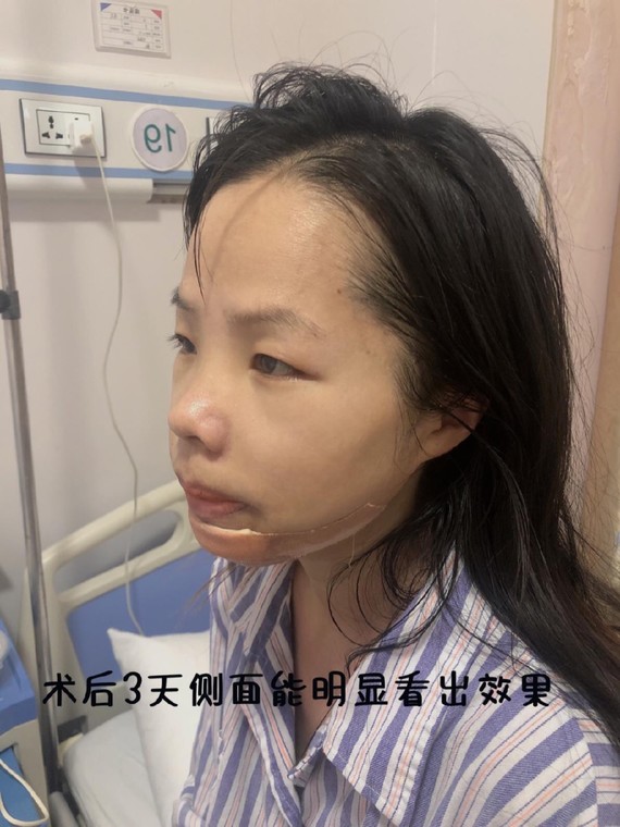 今天说一说我凸嘴矫正的全过程,时间过去三个多月了,这么好的效果真的