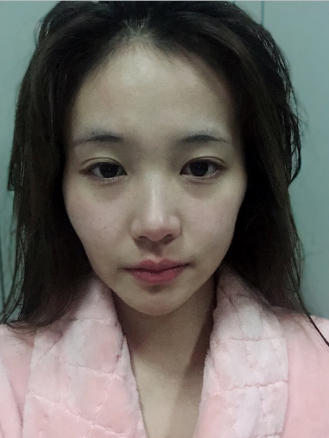 我是个比较瘦小的人,生了孩子后这两年脸颊 眼眶凹陷特别严重!