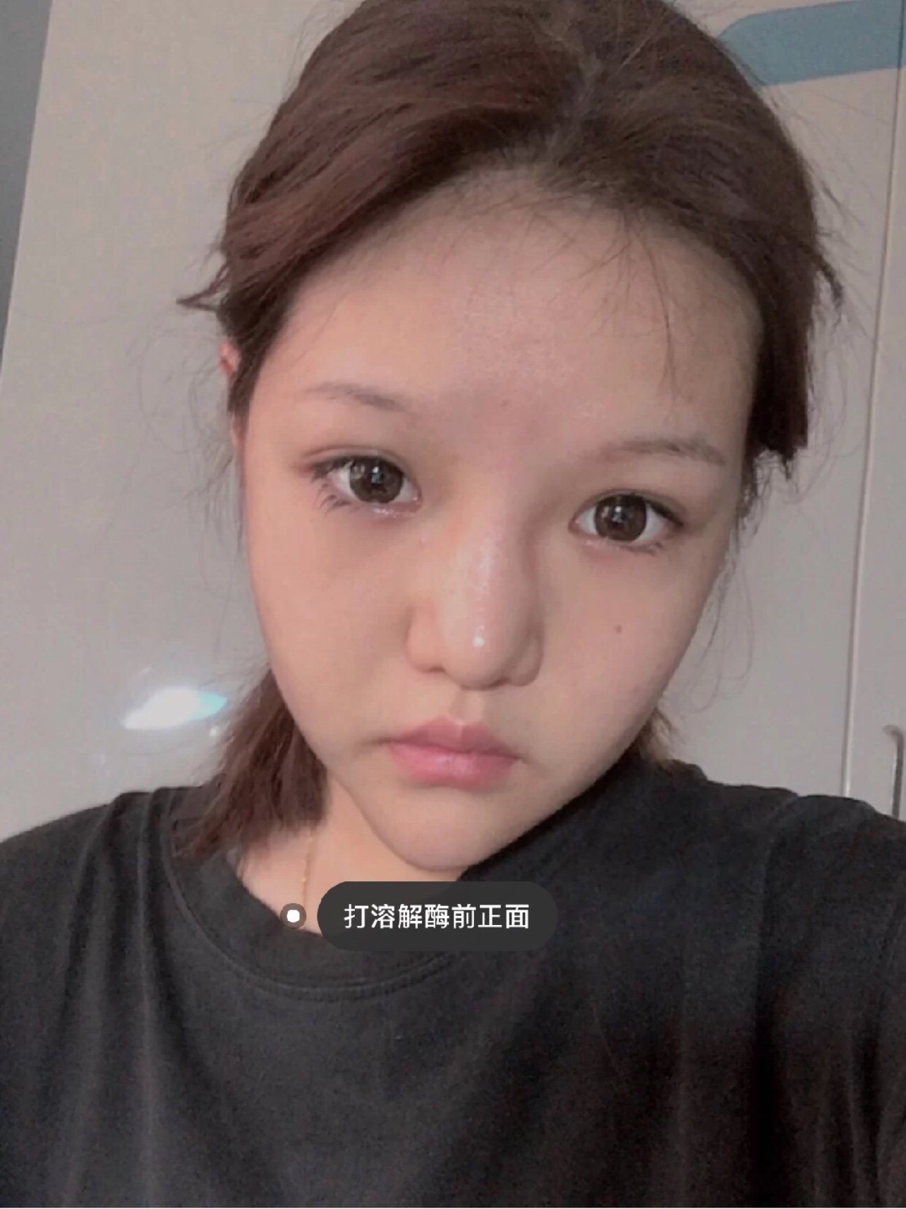 我是一个鼻子无比塌的人,大四的时候选择去打了鼻子(现在毕业