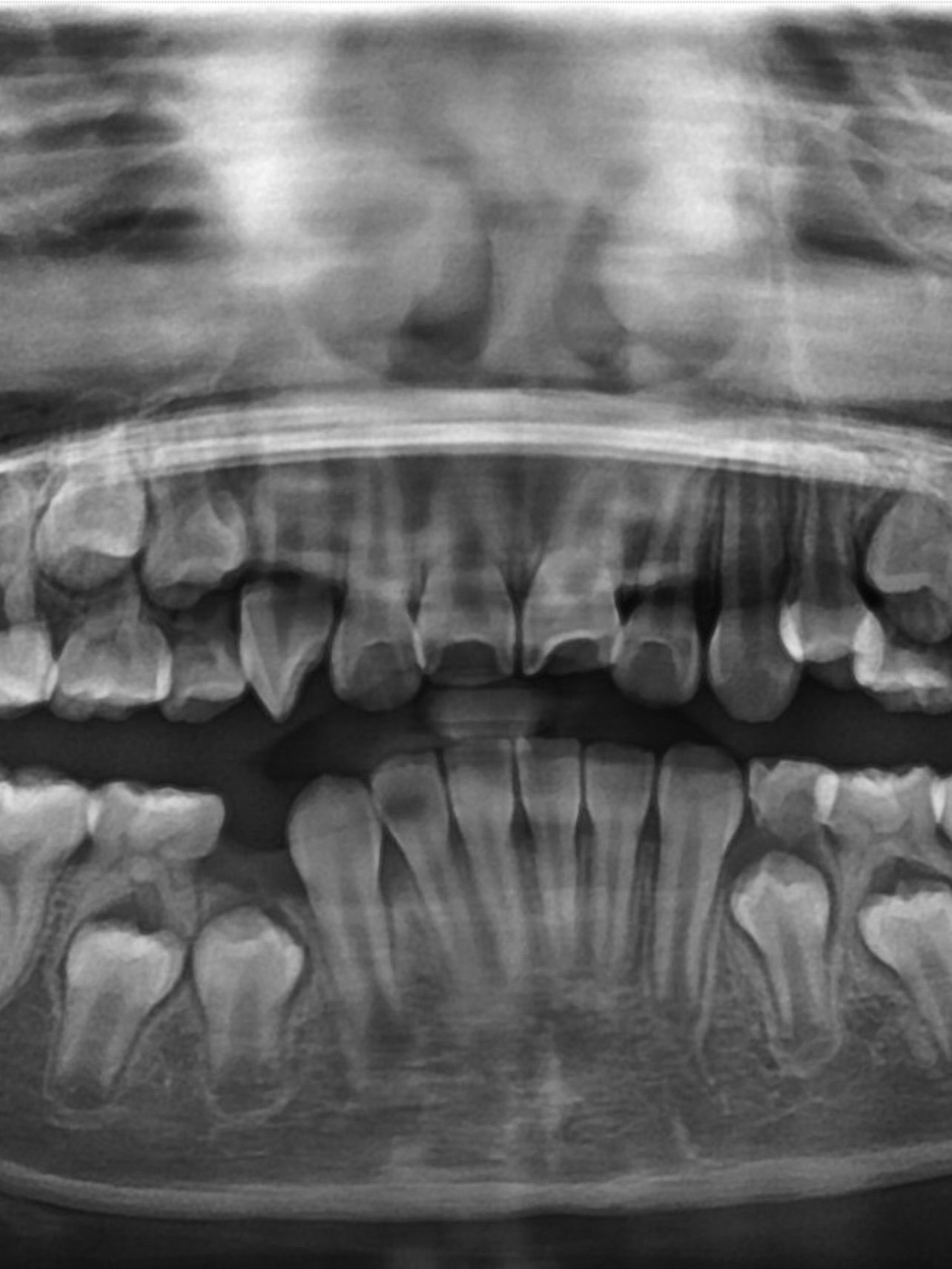 压低前牙升高后牙,扩弓,内收龅牙矫正,但是牙医也有分析我的牙齿方案