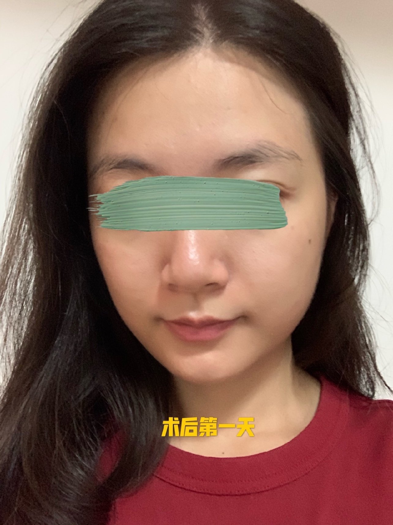 做完光子嫩肤之后的一周情况