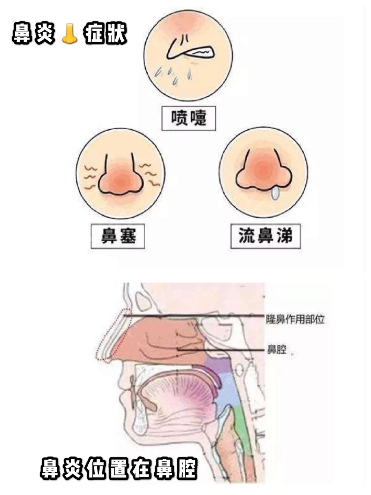 我一个20多年的过敏性鼻炎患者告诉你